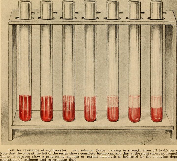 В чем разница между анемией и дефицитом железа. Что из этого в каких случаях и как нужно лечить